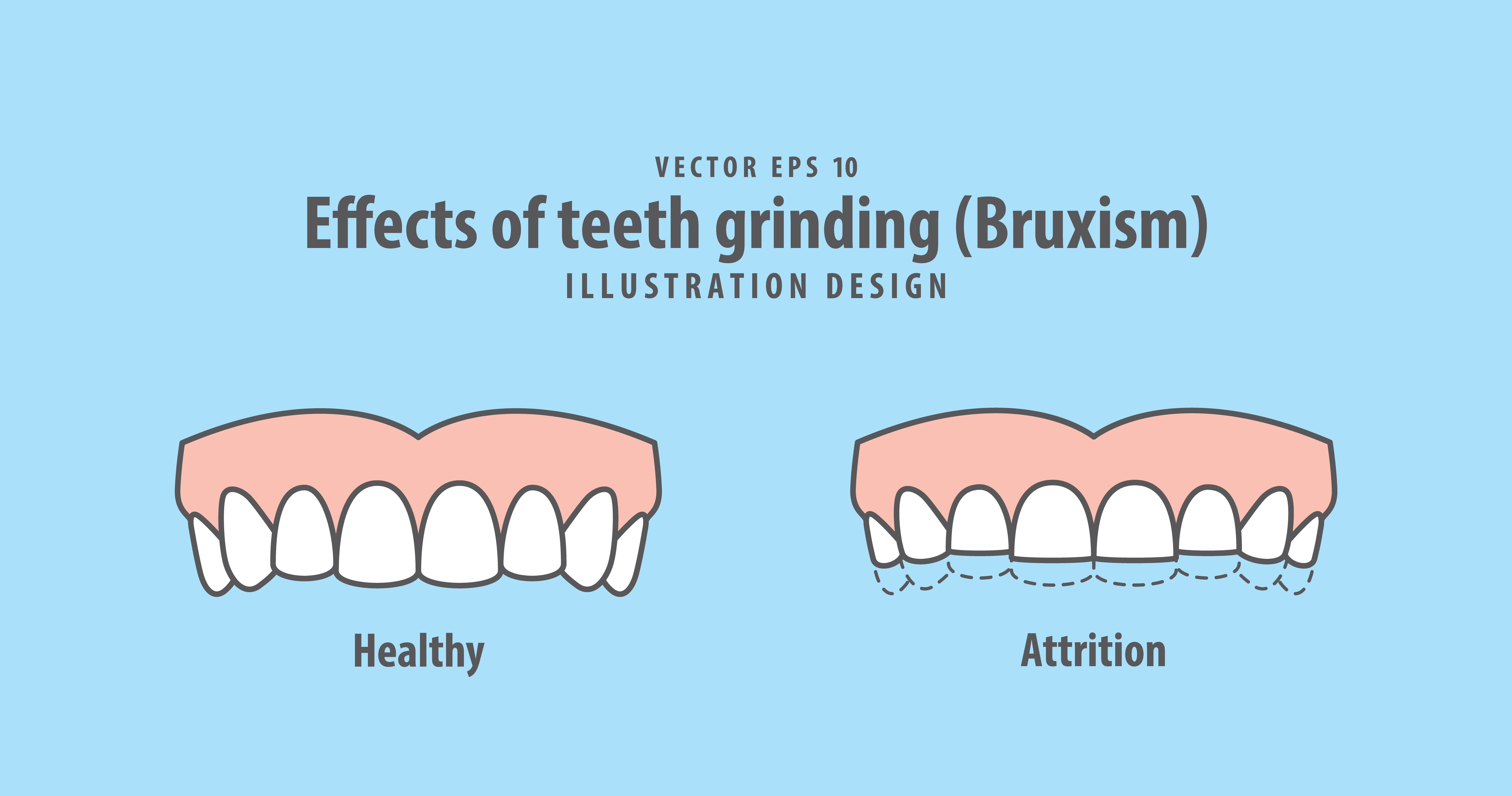 Bruxism  