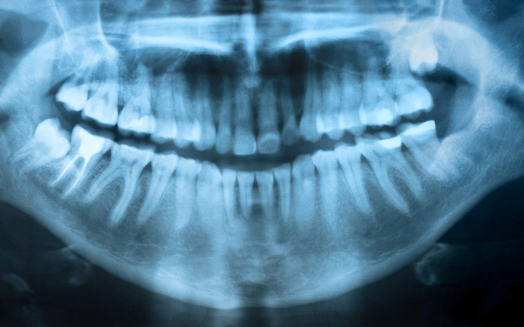 What Does Periodontal Disease and Osteoporosis Have to Do with Each Other?
