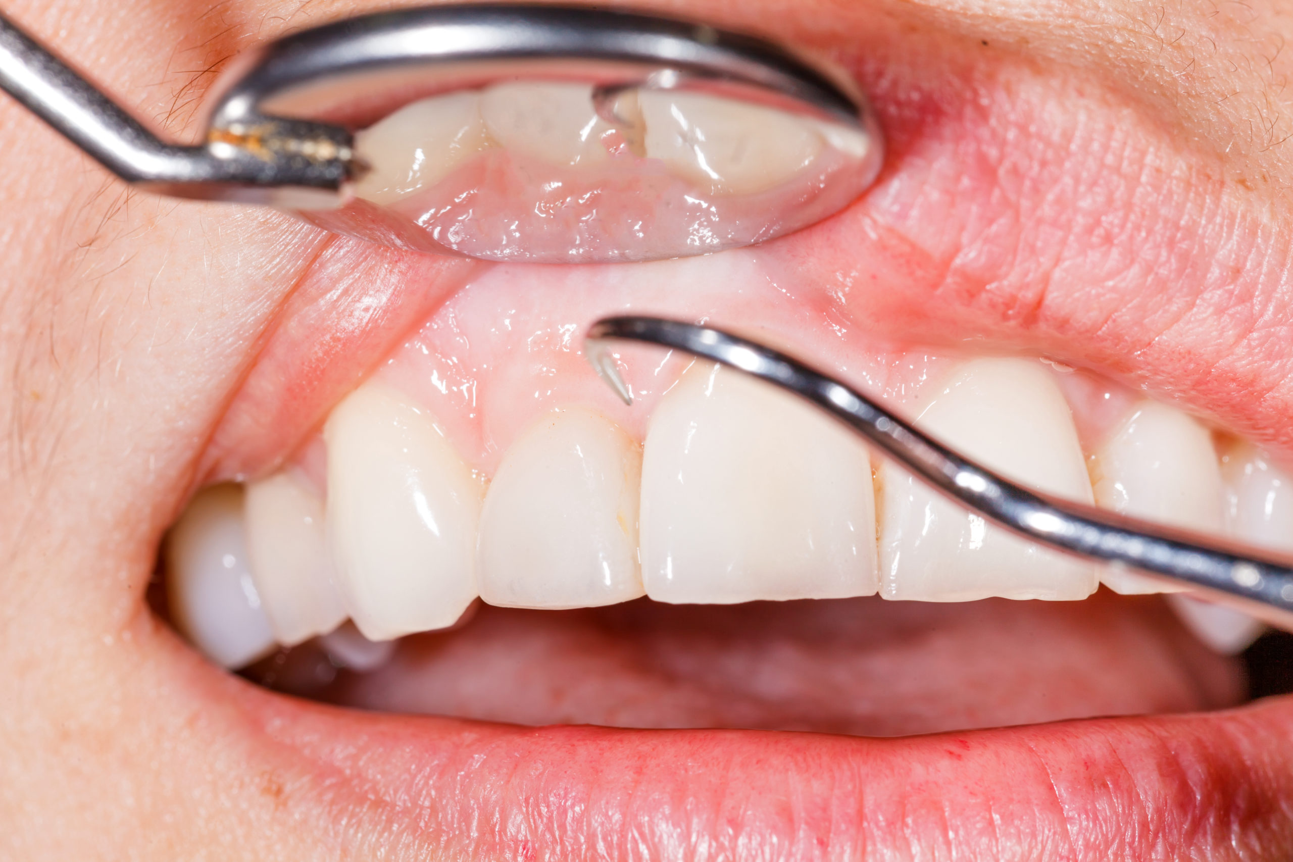 what-is-gum-recession-implant-dentistry-perio-rehab-dr-william