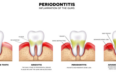 What are the Signs and Symptoms of Periodontal Disease?