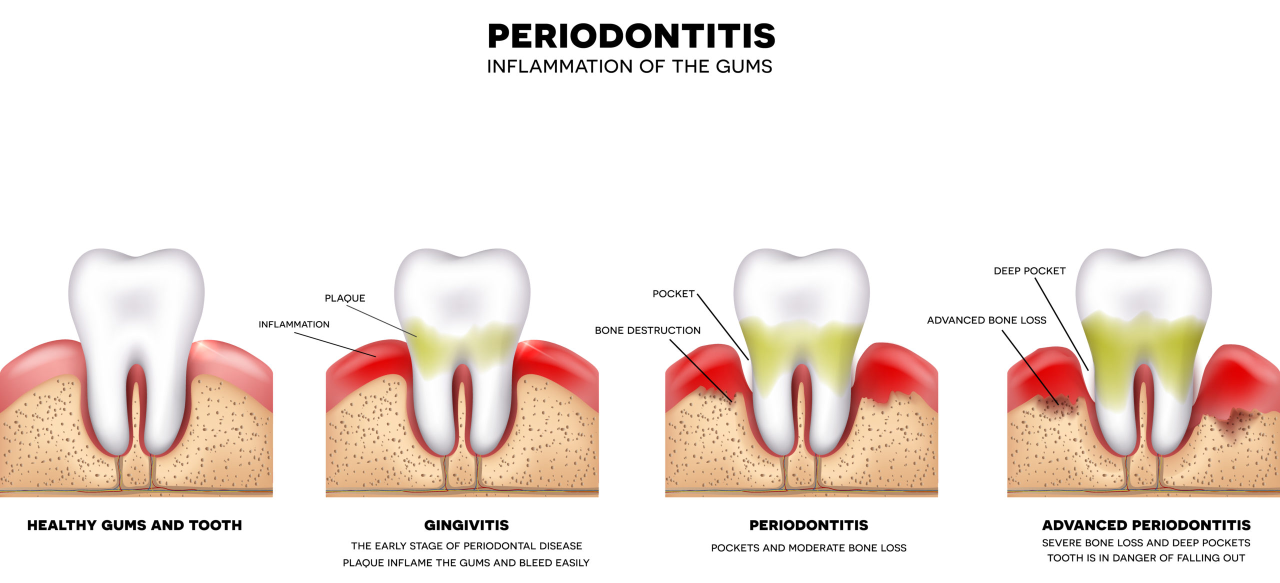 What Are The Signs And Symptoms Of Periodontal Disease? - Implant ...